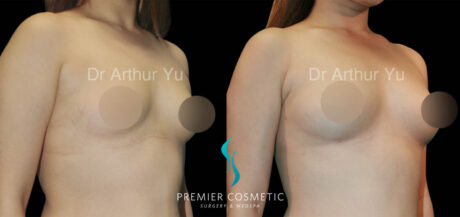 Breast Fat Grafting case #17949