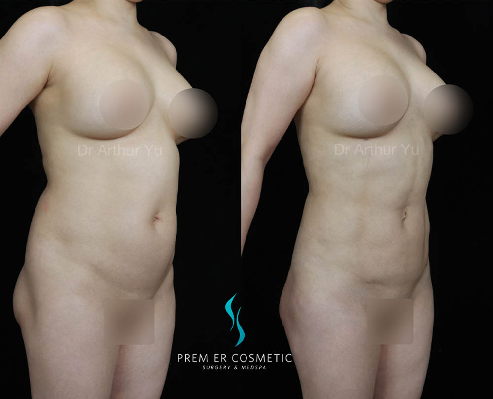 Liposculpture case #18031