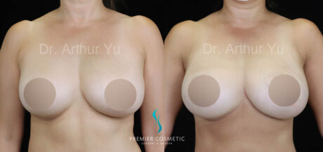 Breast Fat Grafting case #17945