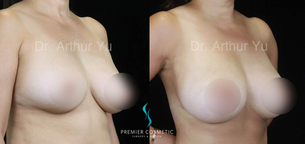 Breast Fat Grafting case #17943