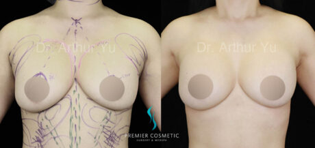 Breast Fat Grafting case #17941
