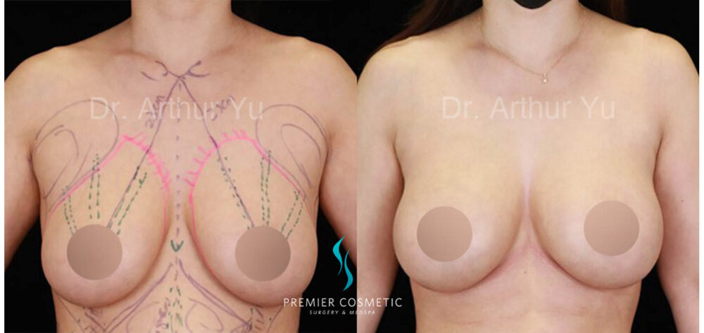 Art TipLyft® case #17939