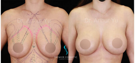 Art TipLyft® case #17939