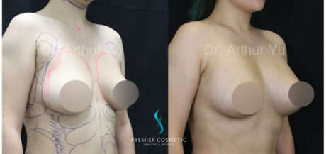 Breast Fat Grafting case #17935
