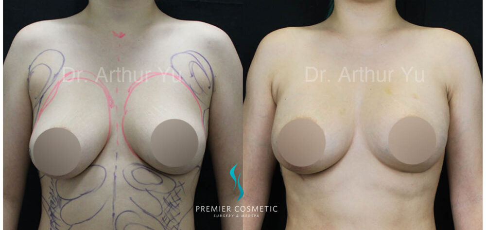 Breast Fat Grafting case #17933