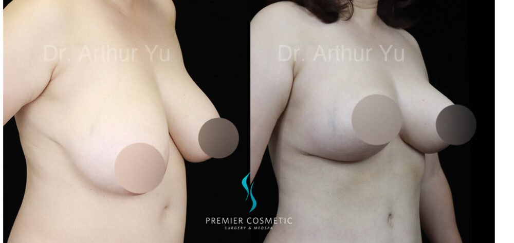 Breast Fat Grafting case #17929