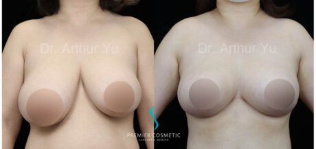 Breast Fat Grafting case #17931