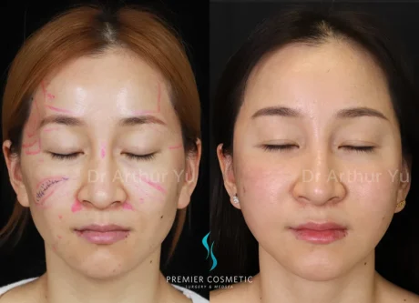 Sculptra case #17899