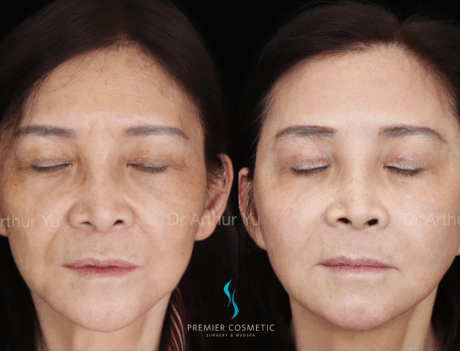 Sculptra case #18037