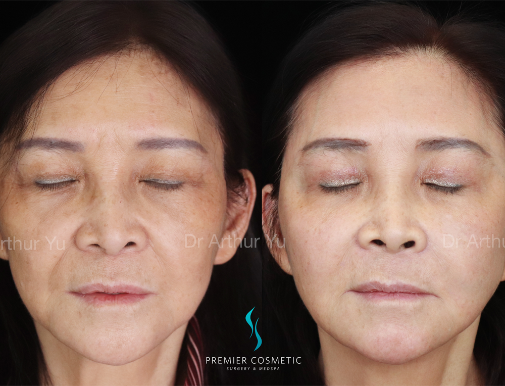 Sculptra case #18037
