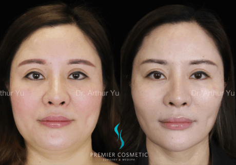 SMAS PDO Thread Lift case #18043