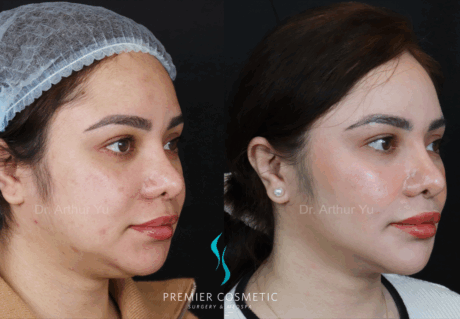 SMAS PDO Thread Lift case #18052