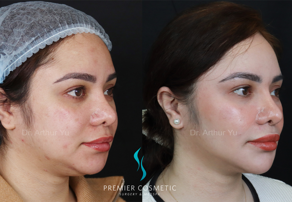 SMAS PDO Thread Lift case #18052