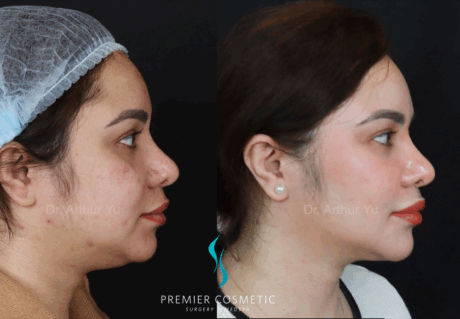 SMAS PDO Thread Lift case #18057