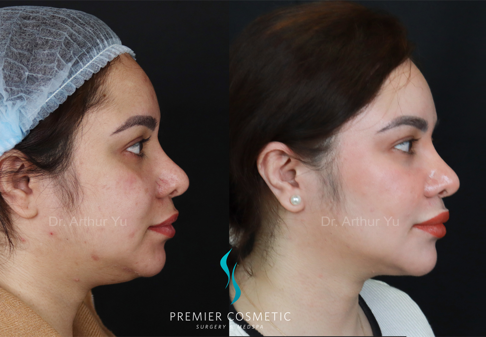 SMAS PDO Thread Lift case #18057