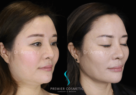 SMAS PDO Thread Lift case #18050