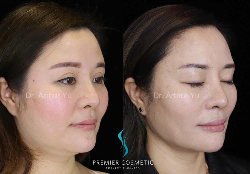 SMAS PDO Thread Lift case #18050