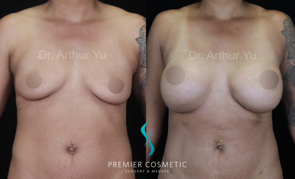 Breast Augmentation case #17920