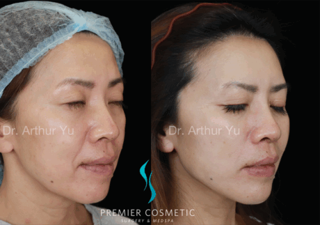 SMAS PDO Thread Lift case #18055