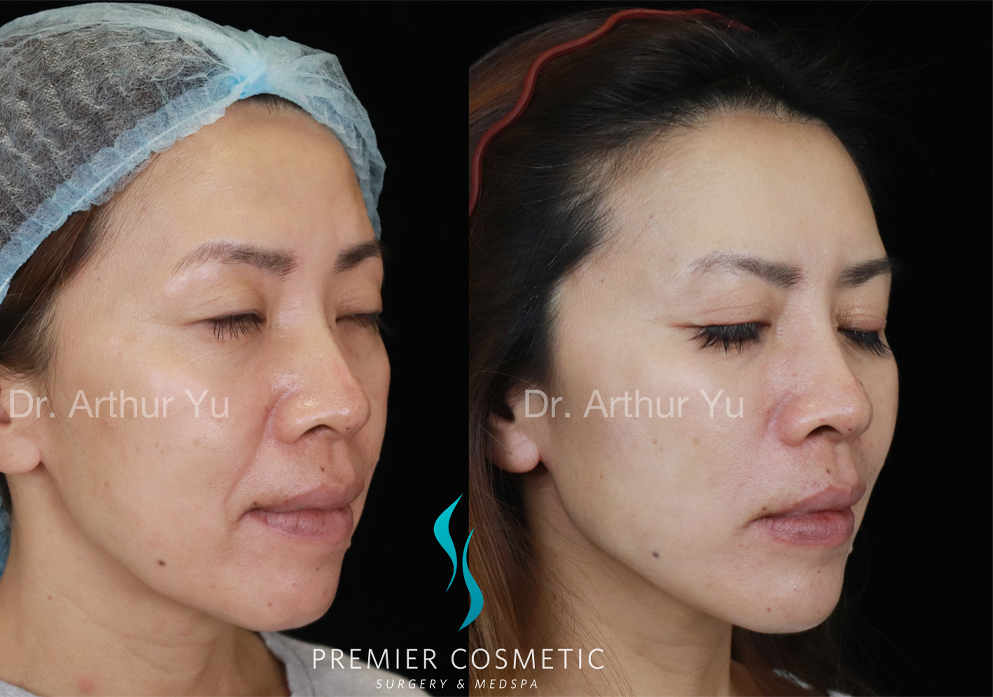 SMAS PDO Thread Lift case #18055