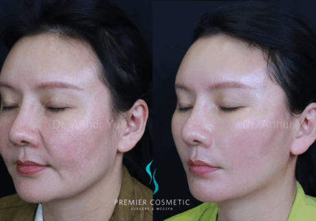 SMAS PDO Thread Lift case #18041