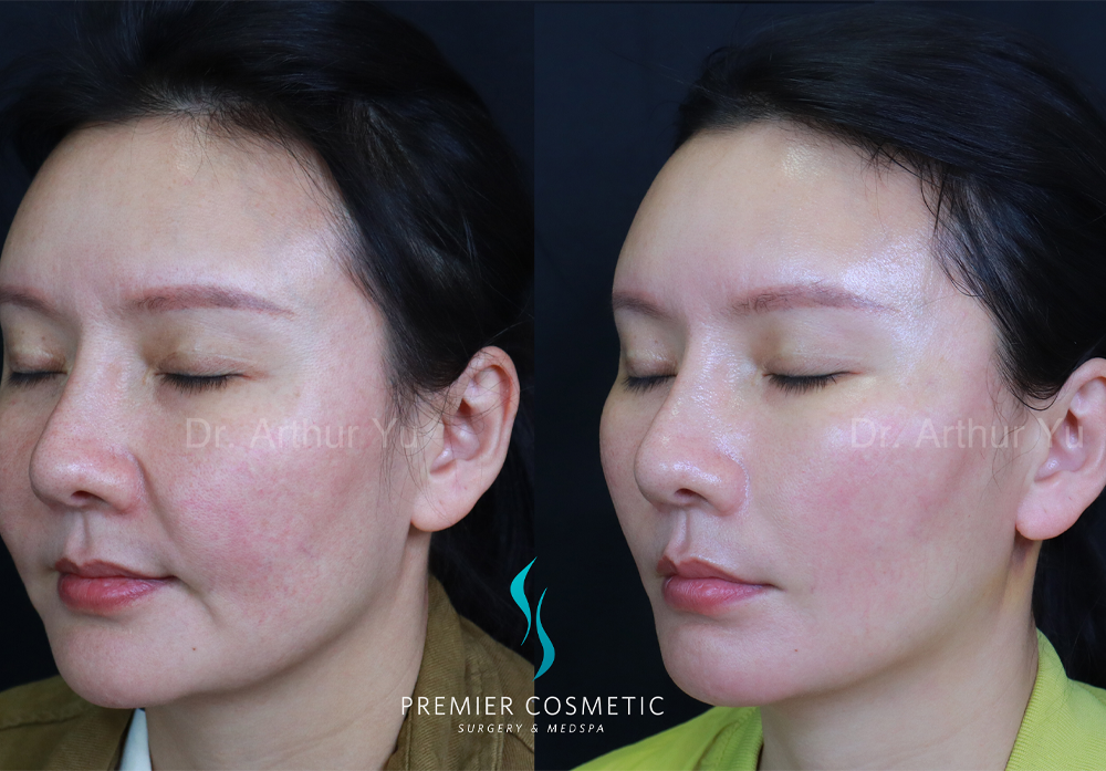 SMAS PDO Thread Lift case #18041