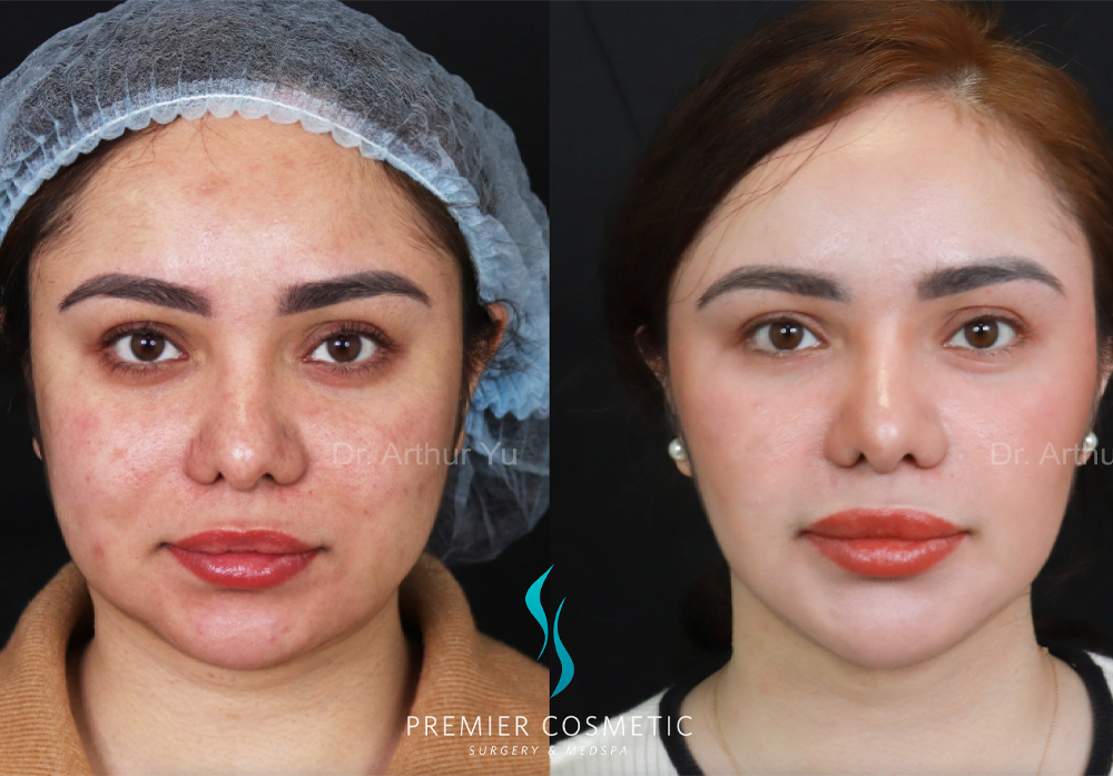 SMAS PDO Thread Lift case #18048