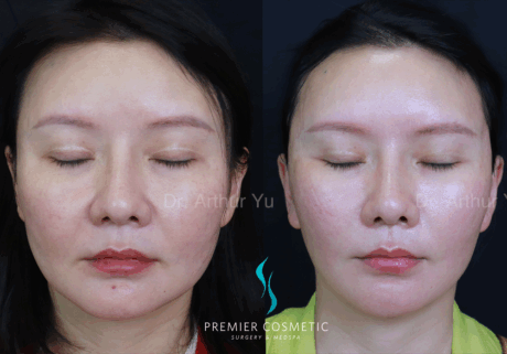 SMAS PDO Thread Lift case #18045