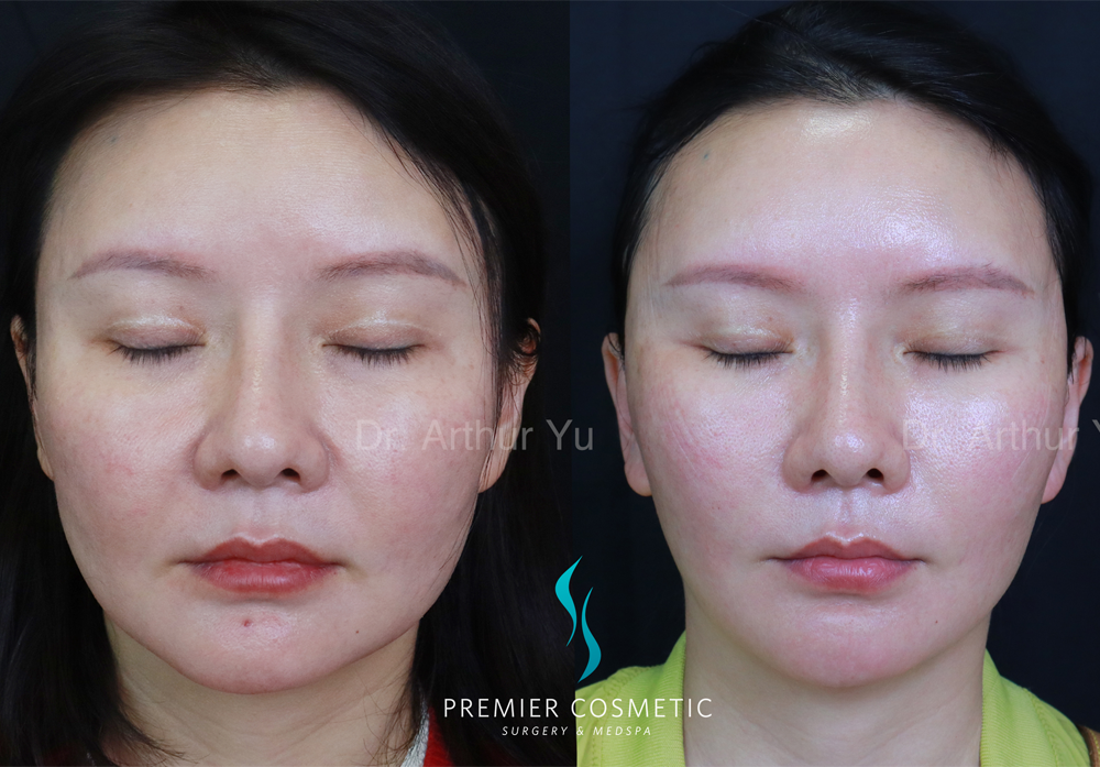 SMAS PDO Thread Lift case #18045