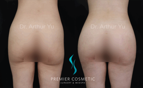 Butt Fat Grafting case #17995