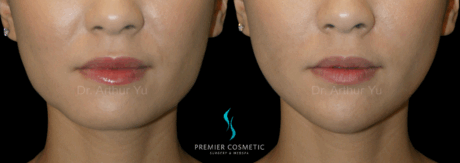 Dermal Filler case #18003