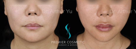 SMAS PDO Thread Lift case #18039