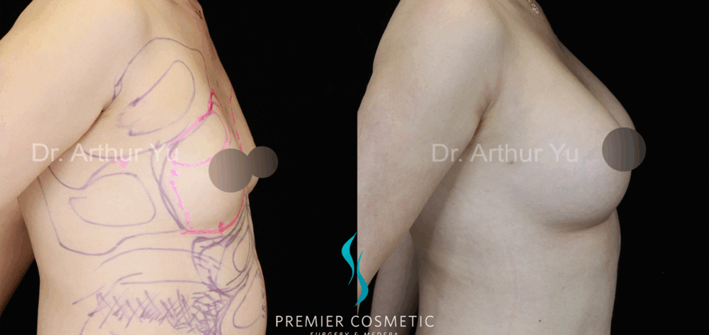 Breast Fat Grafting case #17951