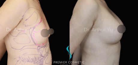 Breast Fat Grafting case #17951