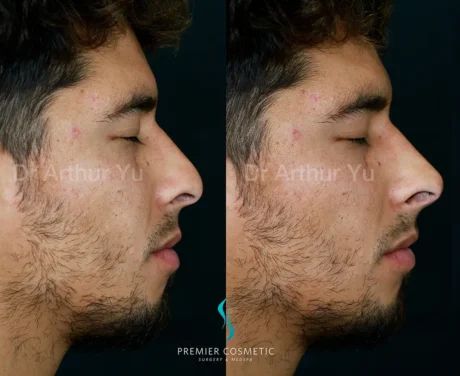 Art TipLyft® case #17904