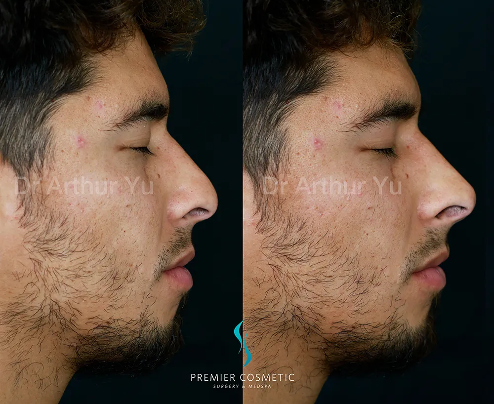 Art TipLyft® case #17904