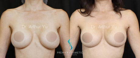 Breast Augmentation case #17922