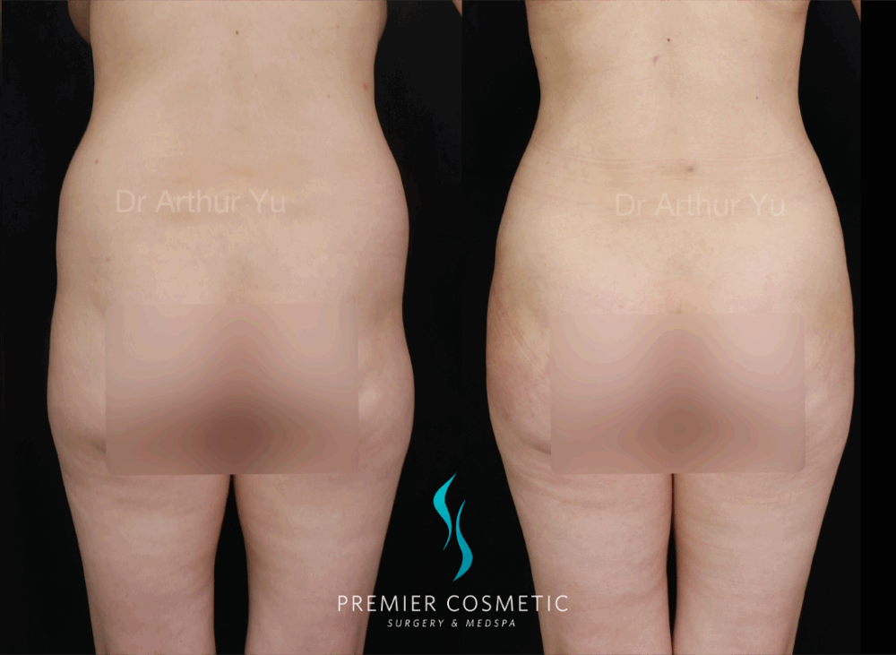 Butt Fat Grafting case #18001