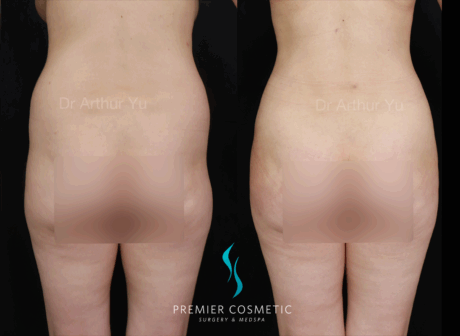 Butt Fat Grafting case #18001