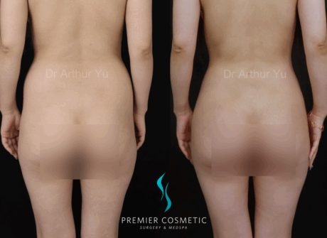 Butt Fat Grafting case #17997