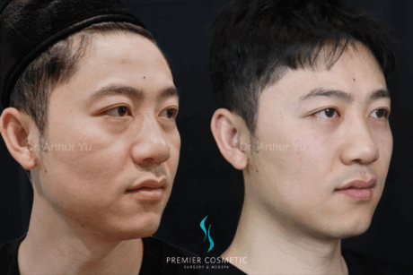 Dermal Filler case #18007