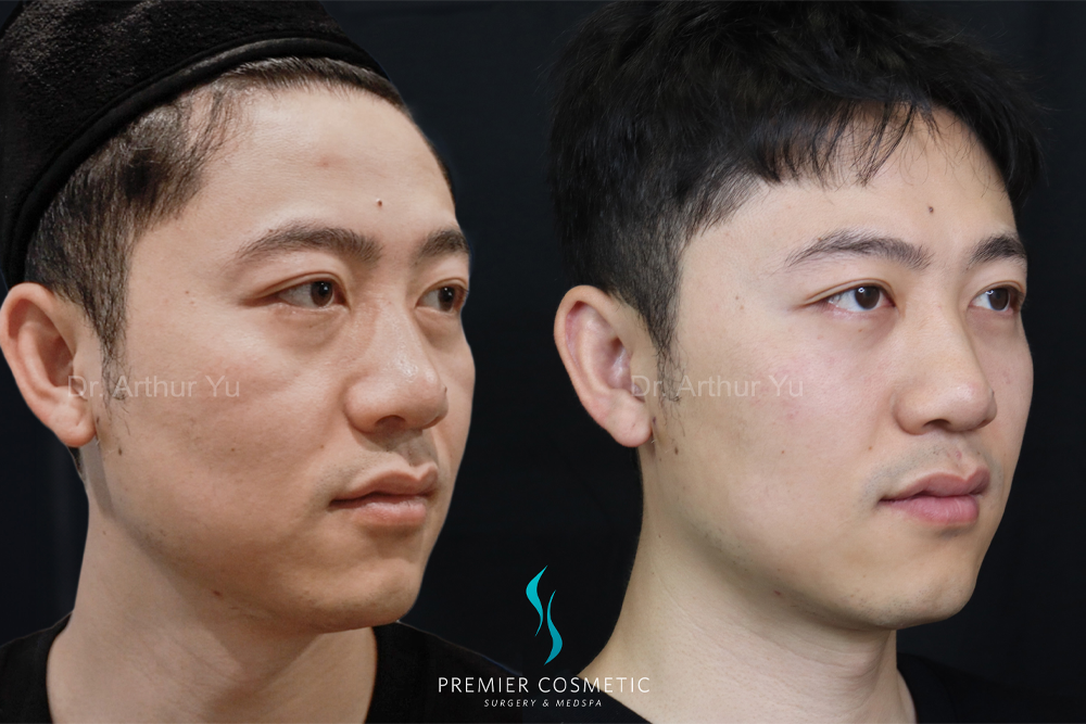 Dermal Filler case #18007