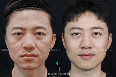 Dermal Filler case #18005