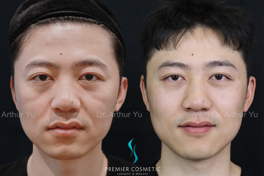 Dermal Filler case #18005