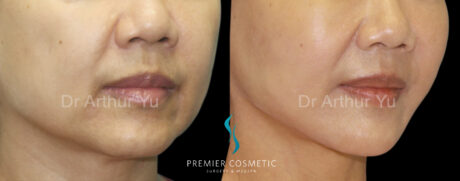 Chin Augmentation case #18291