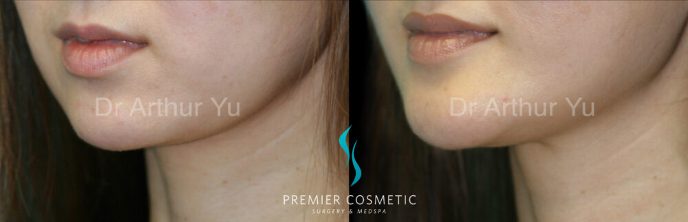 Dermal Filler case #18289