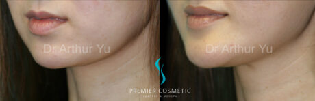 Dermal Filler case #18289