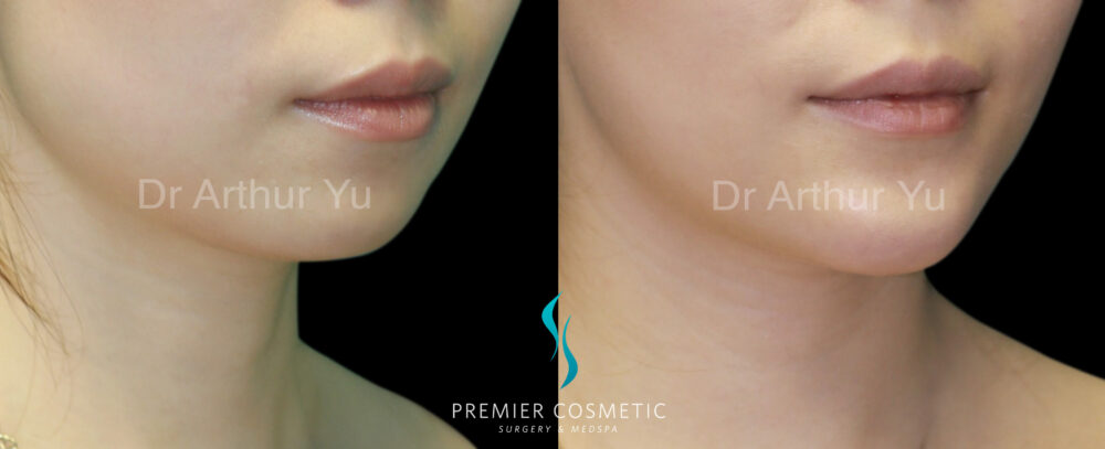 Dermal Filler case #18287