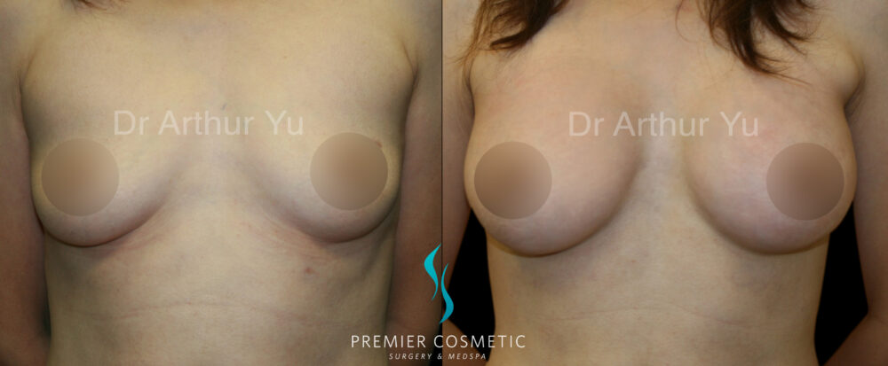 Breast Augmentation case #18317