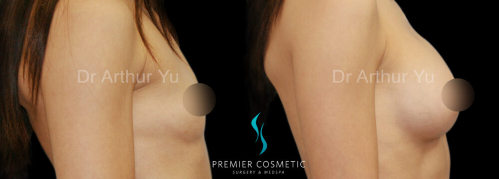 Breast Augmentation case #18357